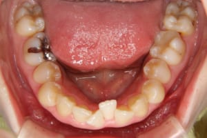 下の前歯に叢生があり歯が重なっています